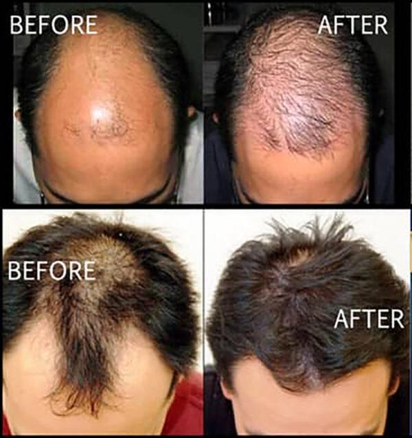 Kirkland Minoxidil 5% Hair Regrowth Solution Extra Strength Men 1 Month Supply Hair Care Comfort