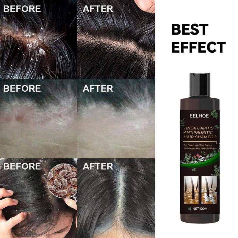 Scalp Repair Biological Shampoo,Anti Itch Dandruff Shampoo,Tinea Capitis Antipruritic Hair Shampoo,Dandruff Treatment Shampoo,Deep into the Roots,Protect the Hair Follicles black  Conditioner Haircare Aloe Comfort Cleanser Cleansing Conditioner Haircare