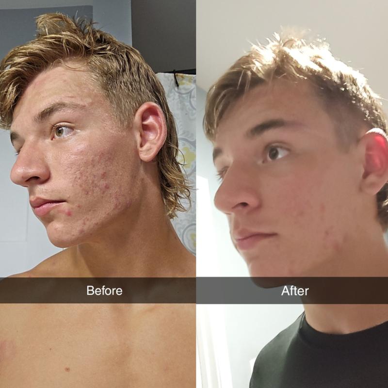 Shield System | Acne System for Men | Face Wash, Moisturizer, Pimple Patches