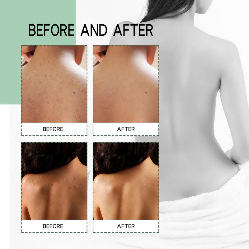 Back Acne Repair Spray, Repair Body Acne Fade Acne Mark Skin Care Spray Gentle Moisturize