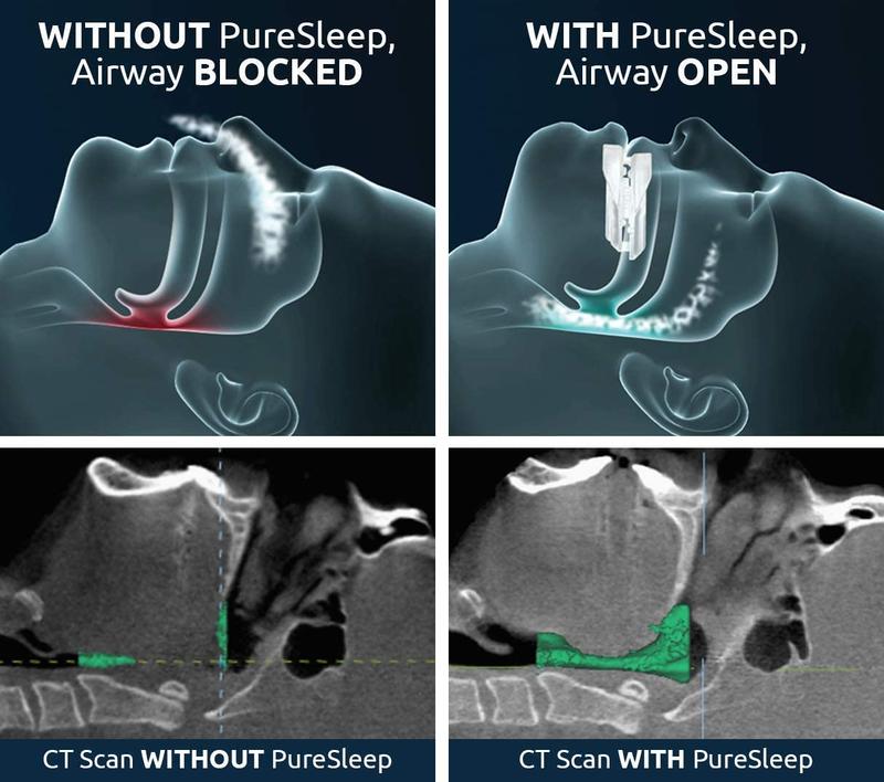 PureSleep, The Original Anti-Snoring Mouthpiece and #1 Solution Worldwide