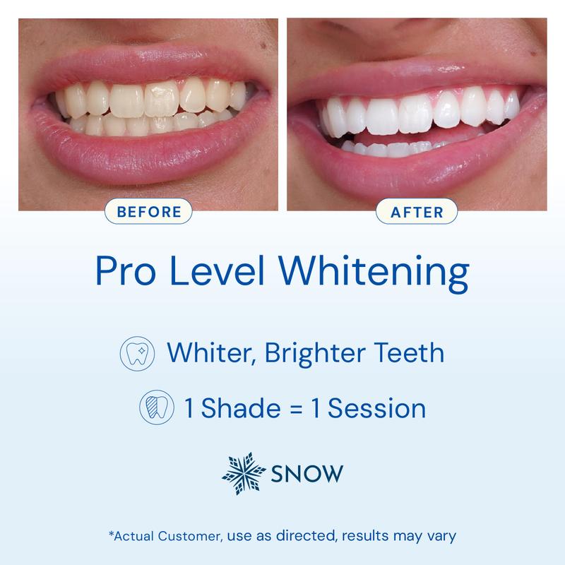 SNOW Accelerating LED Teeth Whitening Mouthpiece | Whitens Teeth | Accelerates Whitening Results | Gentle & Enamel Safe