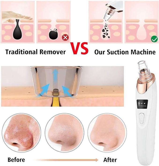 Blackhead Remover Pore Vacuum Kit - 2024 Upgraded Blackhead Extractor Tool with 3 Adjustable Suction Levels, 5 Probes, USB Rechargeable, Suitable for Women and Men Facial Blackhead Removal Cleansing Comfort Gentle