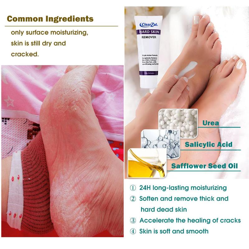 Clearzal Dry  Cracked Feet Repair Ultra-Hydrating Hand and Foot Cream Hard Skin Moisturizer, 3.5 oz. Contains Urea, Salicylic Acid, for Dry, Chapped, Cracked Feet, Dead Skin Remover, For Thick, Cracked, Rough Skin , dead skin and dry skin cream repair