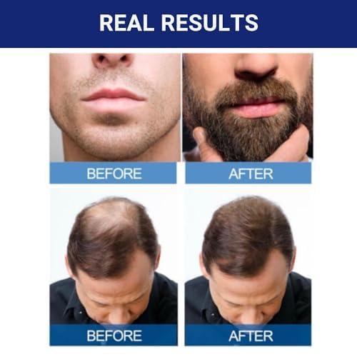 2 MONTHS KIRKLAND MINOXIDIL 5% MENS EXTRA STRENGTH HAIR LOSS REGROWTH SOLUTION