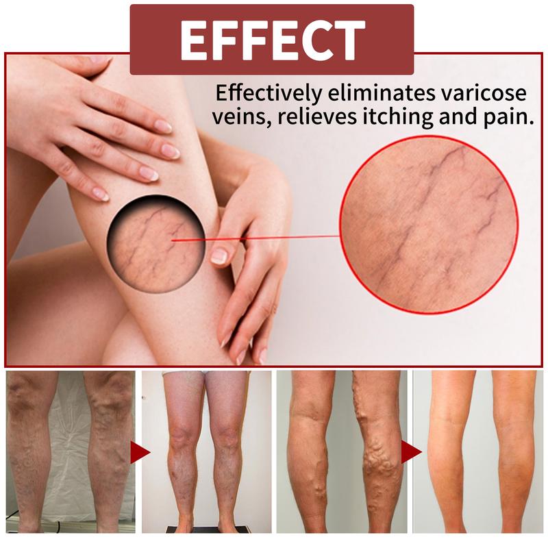 Vein Massage Varicose ointment relieves bulging leg blood vessels swollen leg earthworm leg vein massage cream Body Care Moisturizer